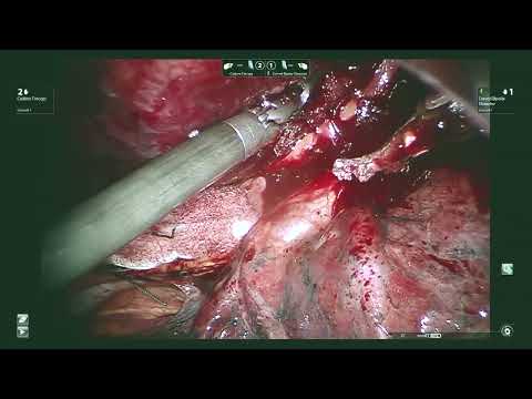 Robotic Radical Thymectomy for MG with Thymoma An Assortment of videos