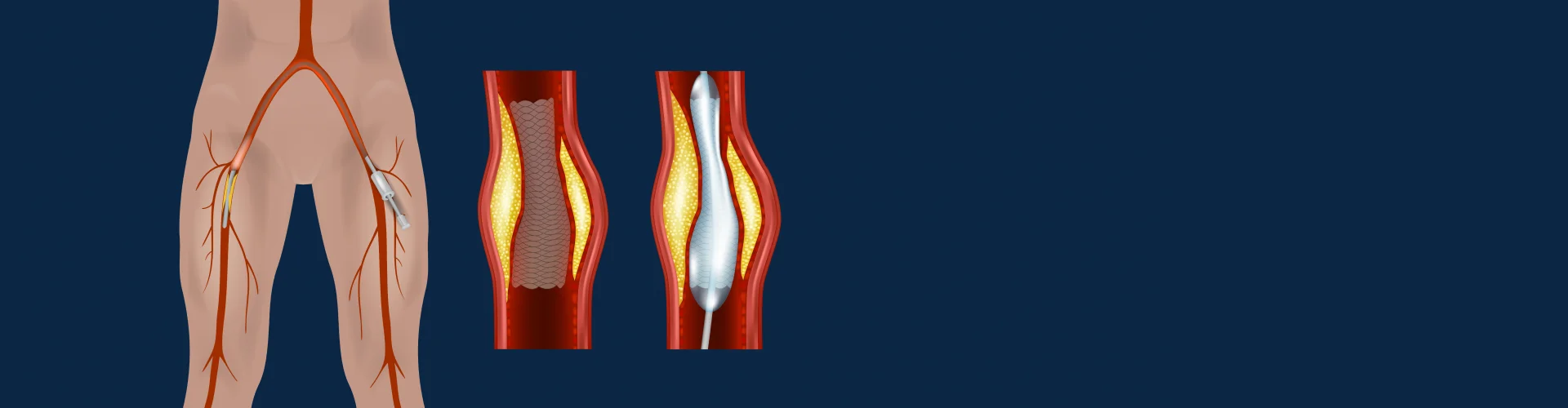 Peripheral Angioplasty: Symptoms, Causes, Recovery & Treatment