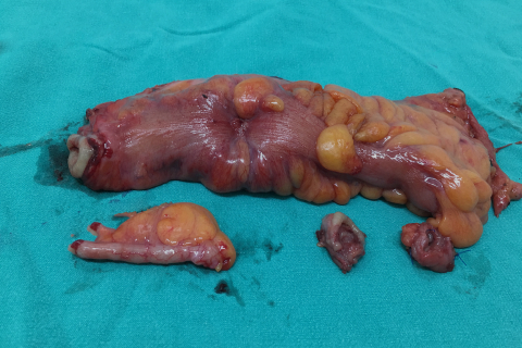 Segmental Colectomy