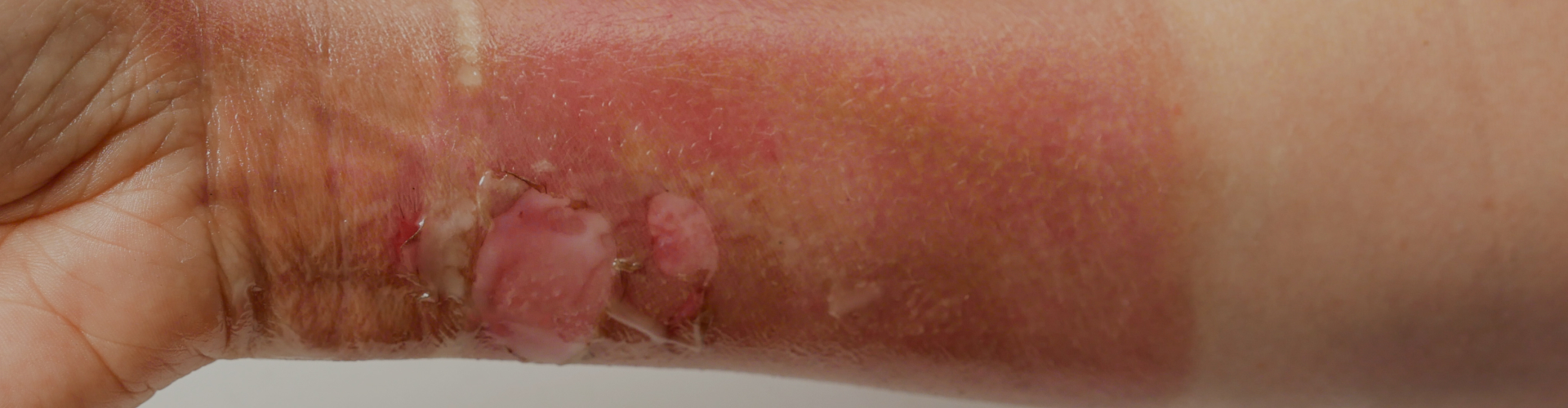 Skin Burns