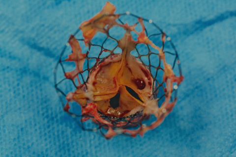 Transcatheter Aortic Valve Implantation (TAVI/ TAVR)