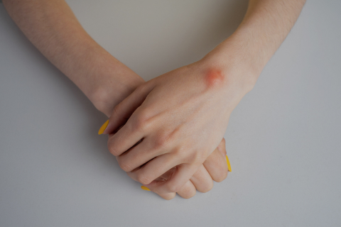 Lipoma