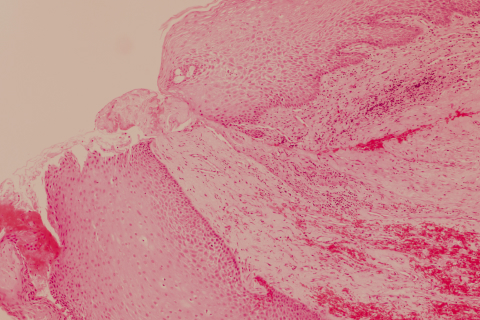 Carcinoma Rectum