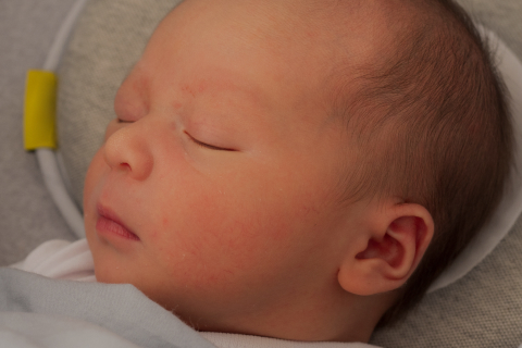 Craniosynostosis