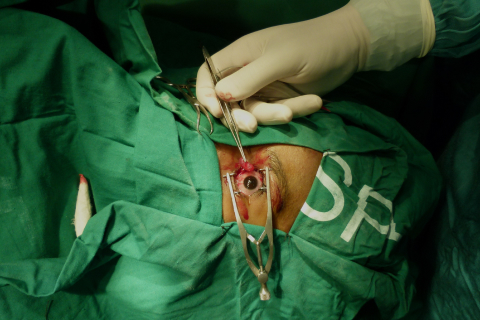 Conjunctiva Cyst Removal