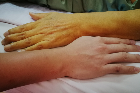 Jaundice