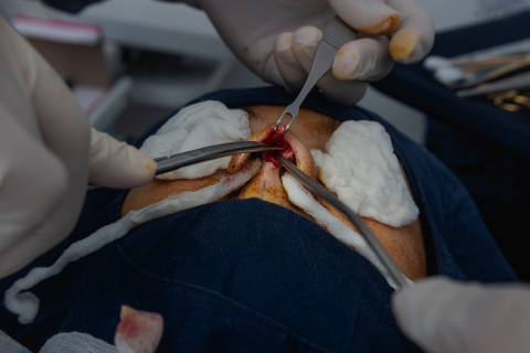 Nasal Tip Plasty