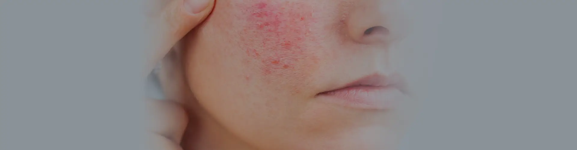 Rosacea: Types, Symptoms, Causes, Stages & Treatment