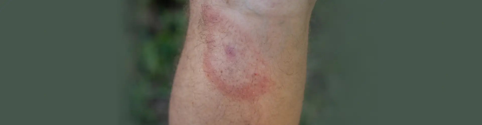 Lyme Disease: Stages, Symptoms, Causes, Diagnosis & Treatment