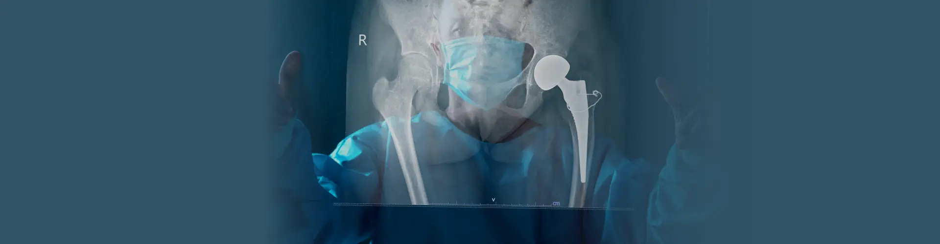 Total Hip Replacement: Procedure, Risks & Recovery
