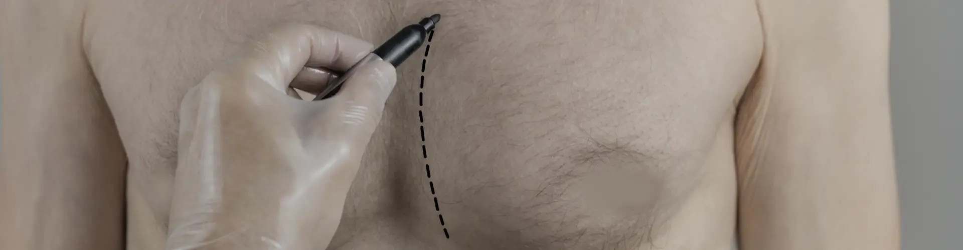 Gynecomastia: Types, Symptoms, Diagnosis and Treatment