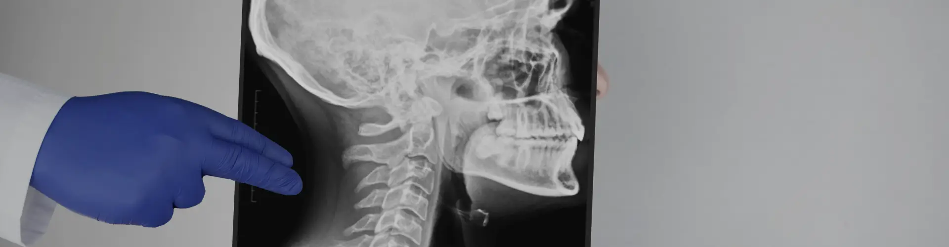 Panfacial Fractures