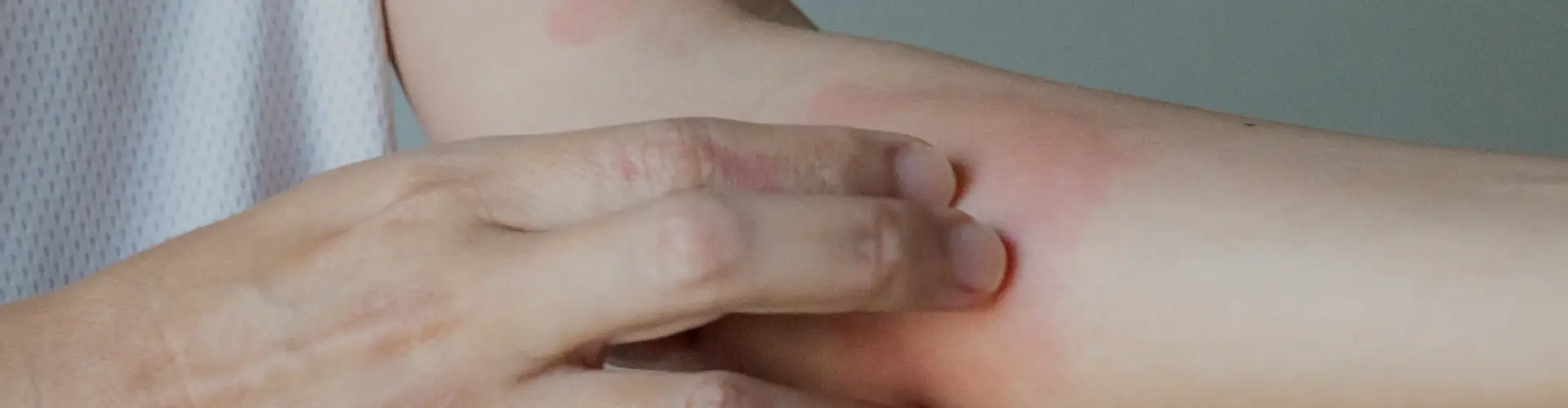 Psoriasis: Types, Symptoms, Causes & Treatment