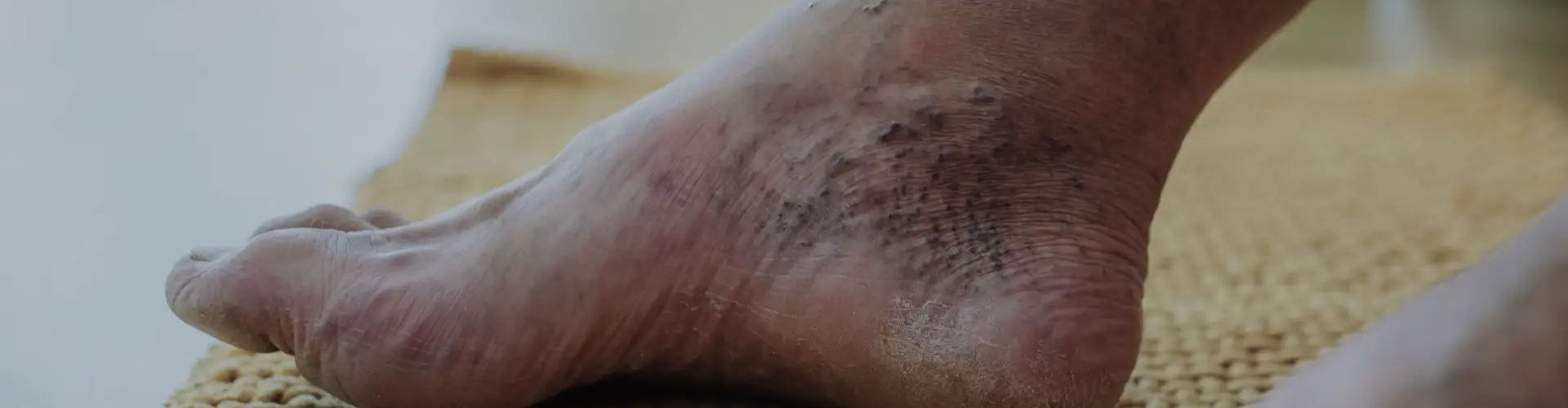 Diabetic Foot and Gangrene: Understanding, Prevention, & Treatment