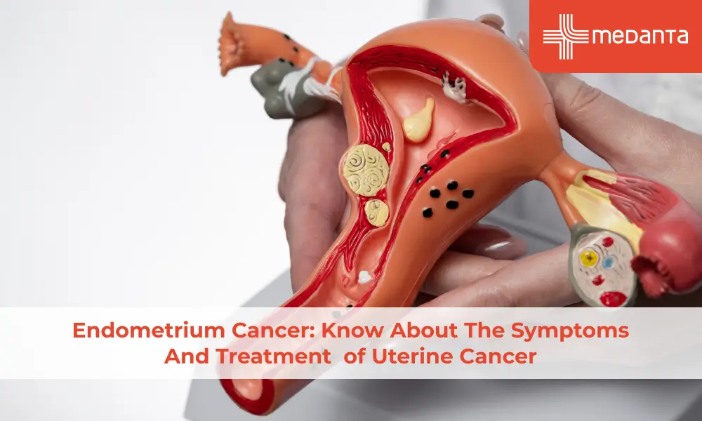 Endometrium Cancer: Know About The Symptoms And Treatment of Uterine Cancer