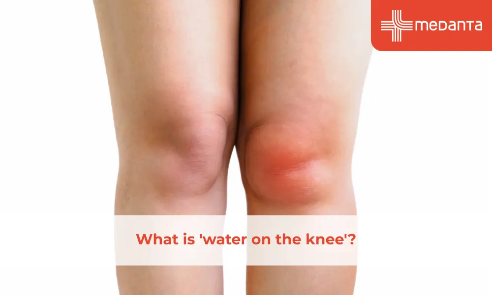 What is 'water on the knee'?