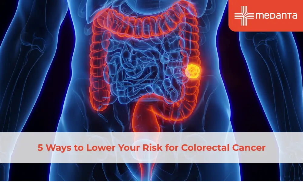 5-ways-to-lower-your-risk-for-colorectal-cancer