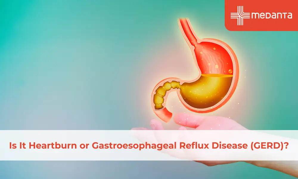 Is It Heartburn or Gastroesophageal Reflux Disease (GERD)?
