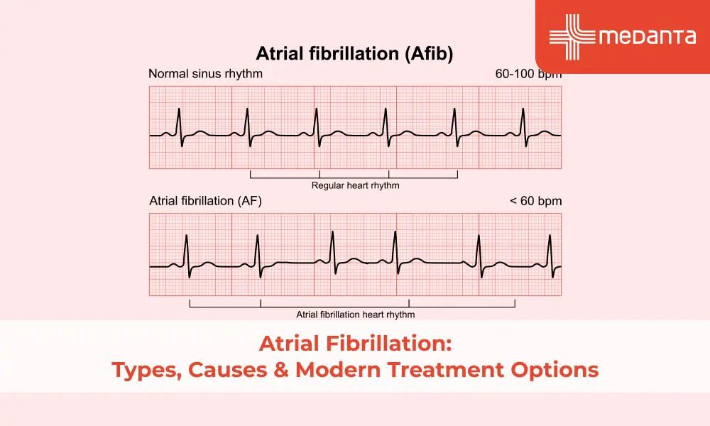 atrial_fibrillation_types_causes_modern_treatment_options