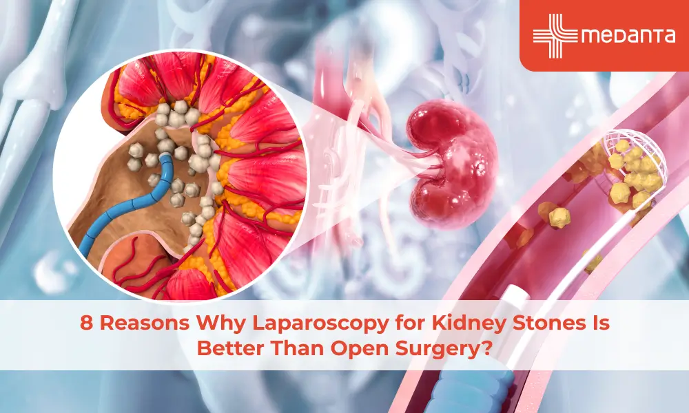 8-reasons-why-laparoscopy-for-kidney-stones-is-better-than-open-surgery