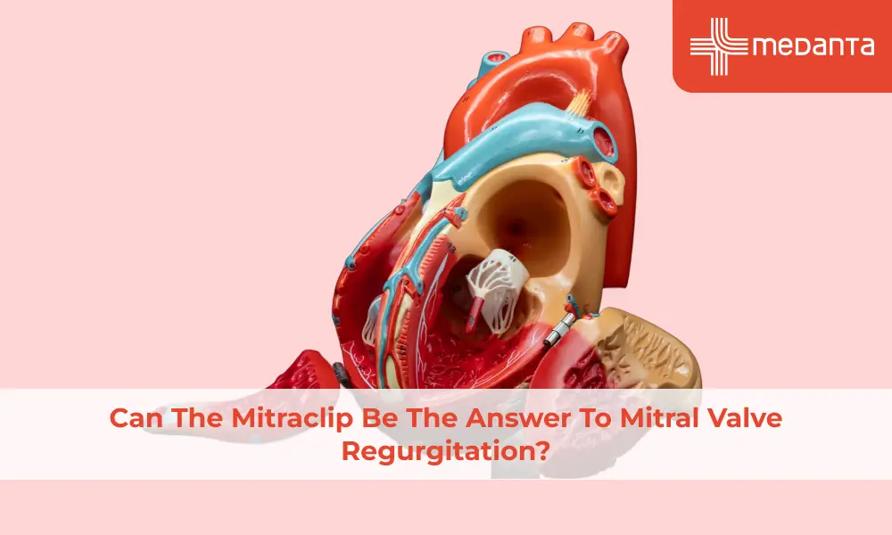 Can The Mitraclip Be The Answer To Mitral Valve Regurgitation?