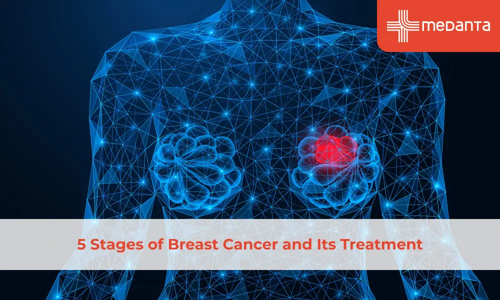 5 Stages of Breast Cancer and Its Treatment