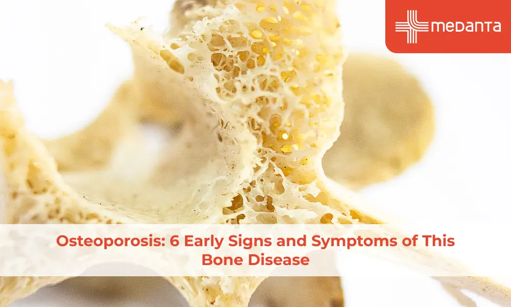Osteoporosis: 6 Early Signs and Symptoms of This Bone Disease
