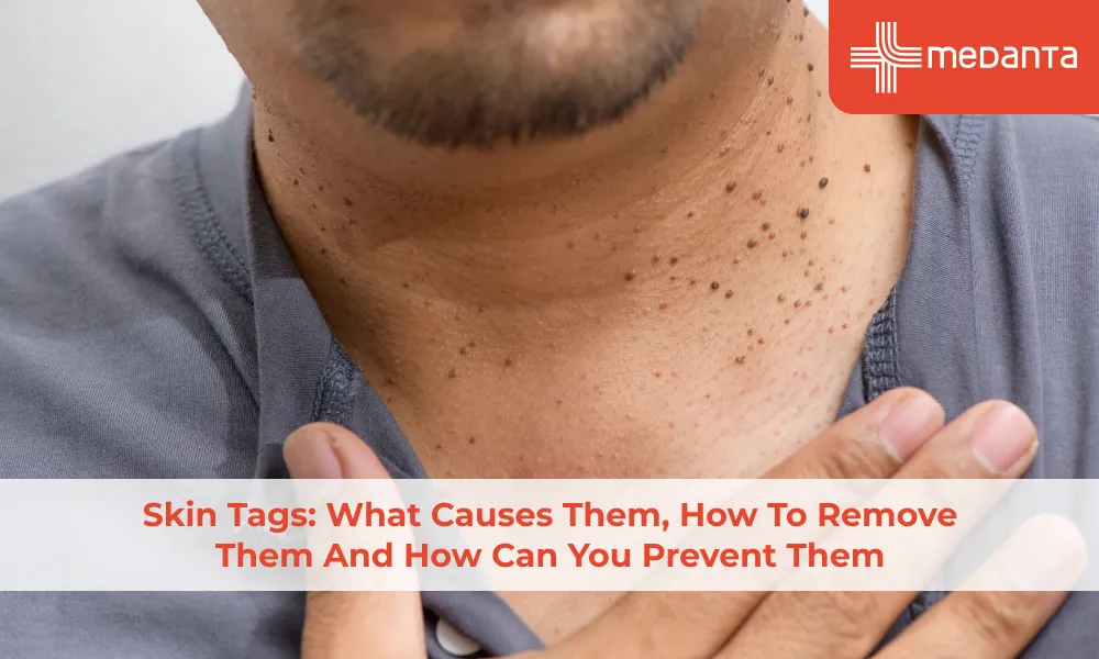 Skin Tags: What Causes Them, How to Remove Them and How Can You Prevent Them