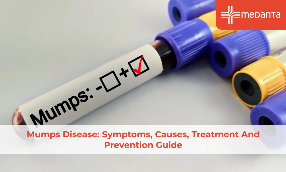 Mumps Disease: Symptoms, Causes, Treatment and Prevention Guide