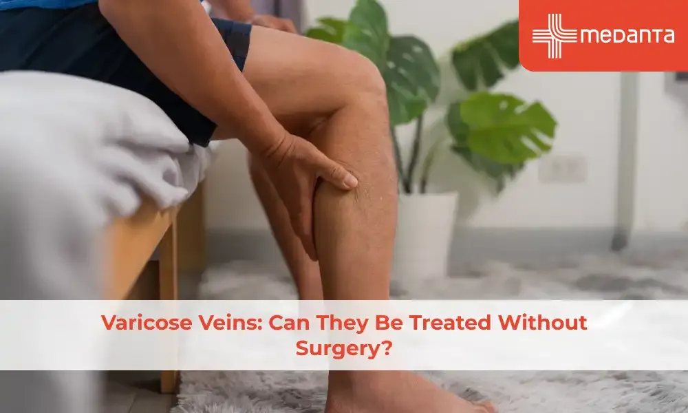 varicose-veins-can-they-be-treated-without-surgery