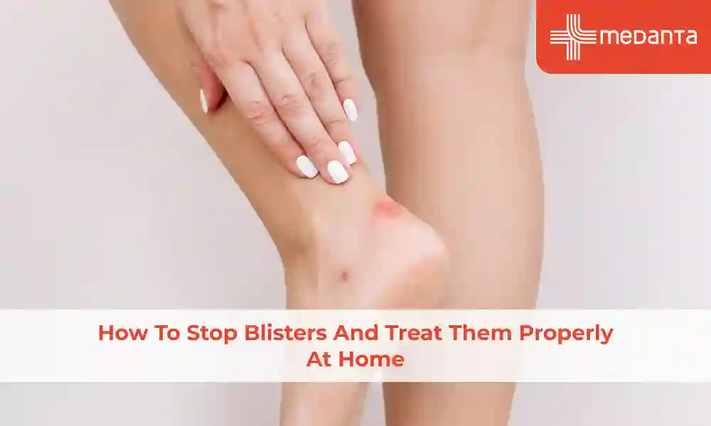 How to Stop Blisters and Treat Them Properly at Home