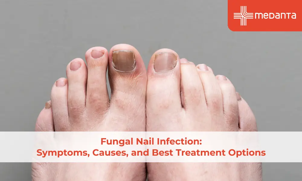 Fungal Nail Infection: Symptoms, Causes, and Best Treatment Options