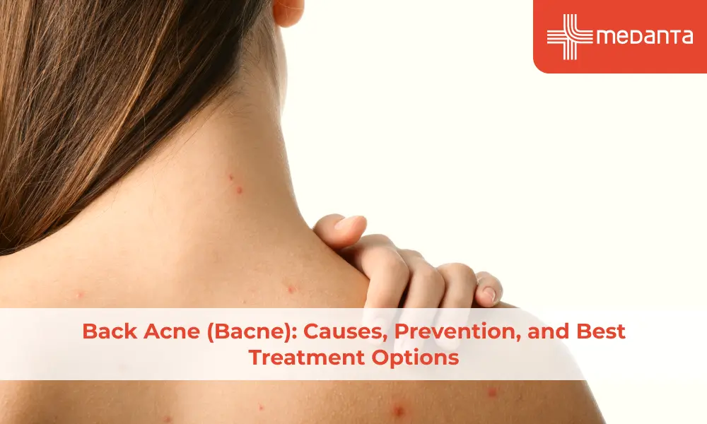 back-acne-bacne-causes-prevention-and-best-treatment-options
