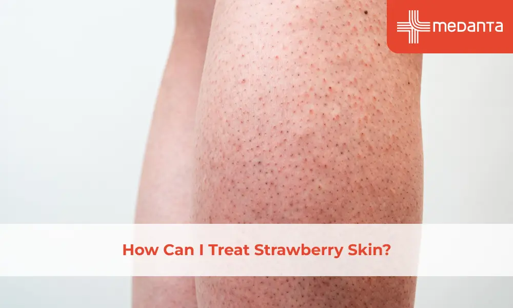 How Can I Treat Strawberry Skin?