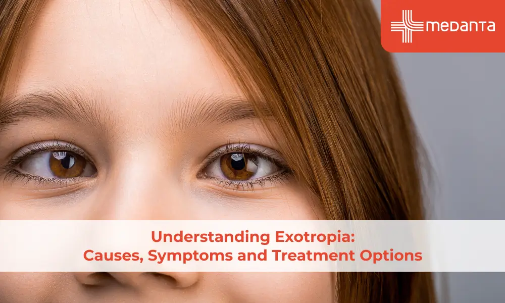 Understanding Exotropia: Causes, Symptoms and Treatment Options