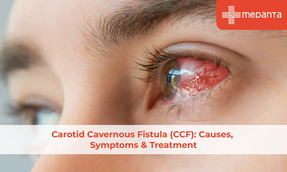 Carotid Cavernous Fistula (CCF): Causes, Symptoms & Treatment
