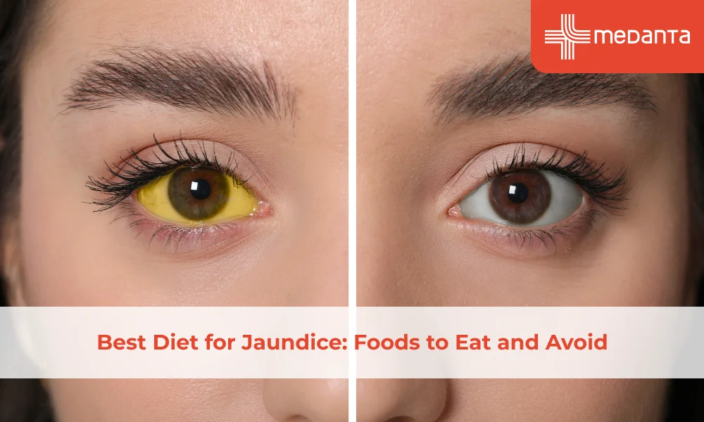 Best Diet for Jaundice: Foods to Eat and Avoid