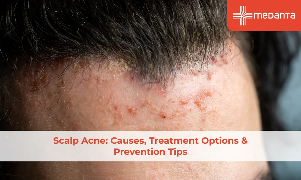 scalp-acne-causes-treatment-options-prevention-tips