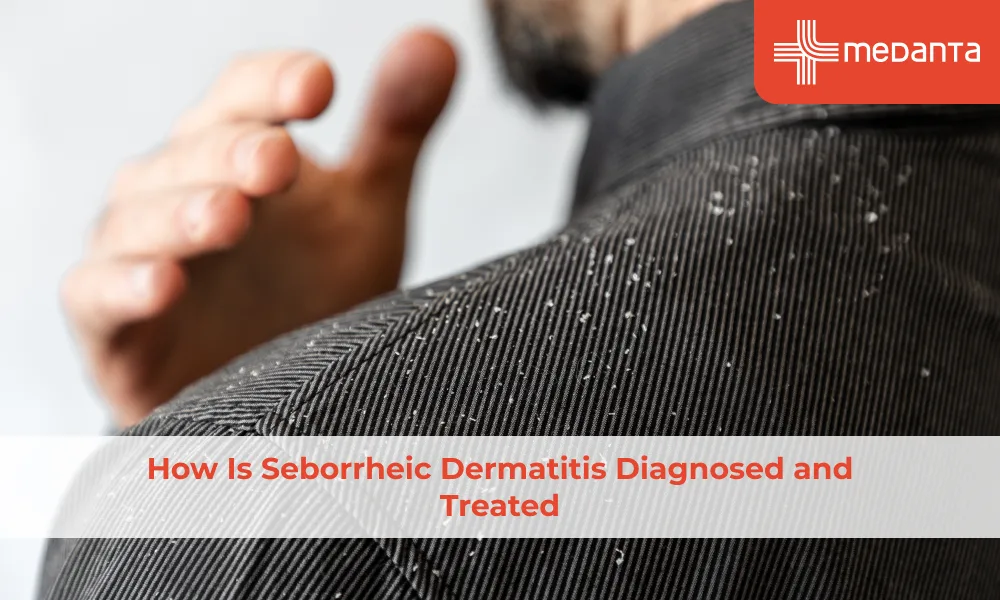 how-is-seborrheic-dermatitis-diagnosed-and-treated