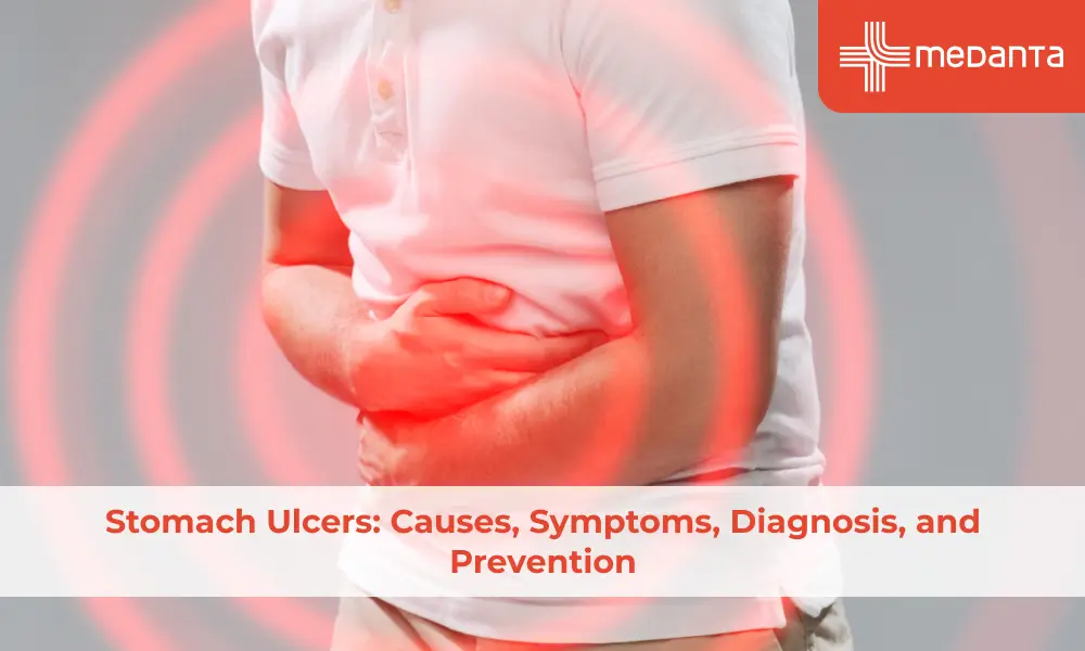 Stomach Ulcers: Causes, Symptoms, Diagnosis, and Prevention