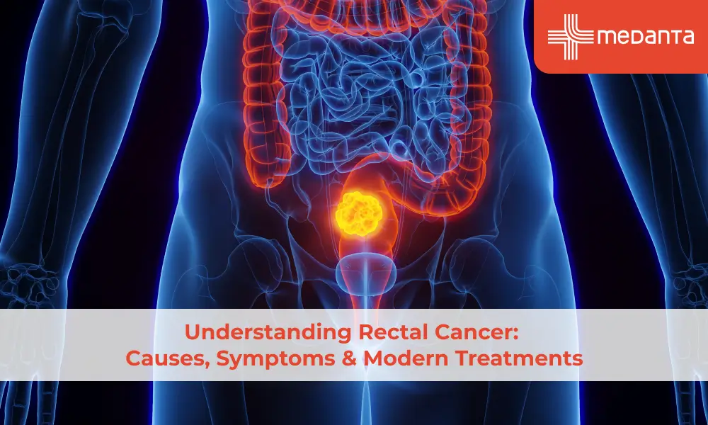 Understanding Rectal Cancer: Causes, Symptoms & Modern Treatments