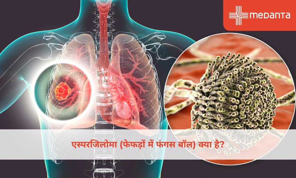 एस्परजिलोमा (फेफड़ों में फंगस बॉल) क्या है?