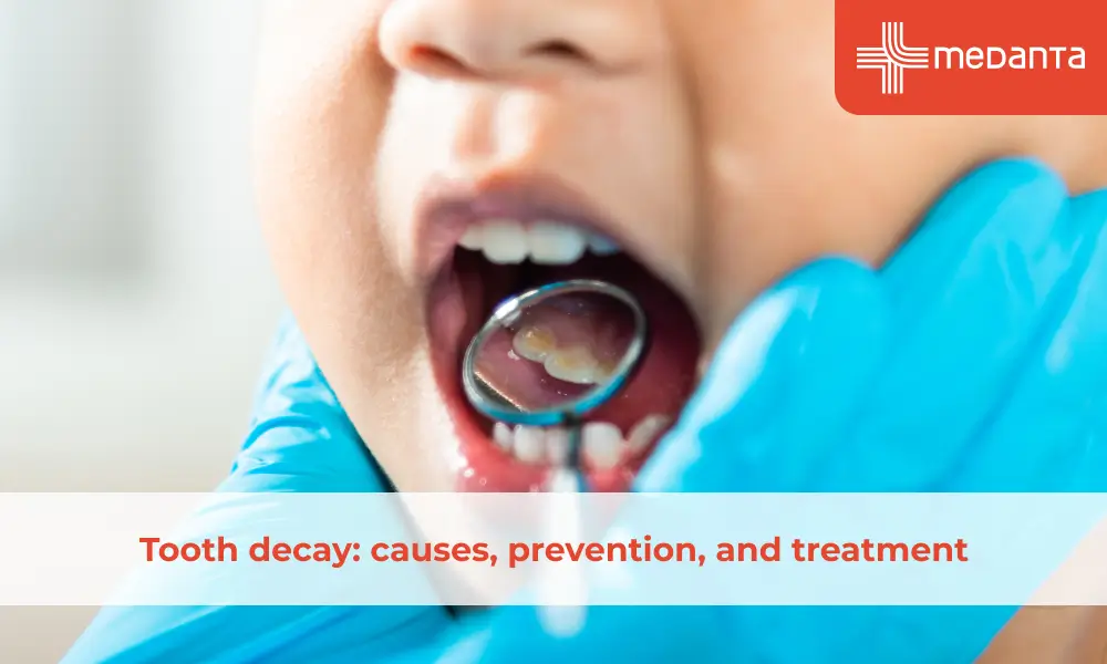 Tooth Decay (Cavities): Causes, Symptoms, Prevention & Treatment