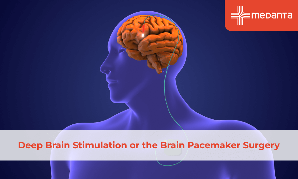 Deep Brain Stimulation or the Brain Pacemaker Surgery