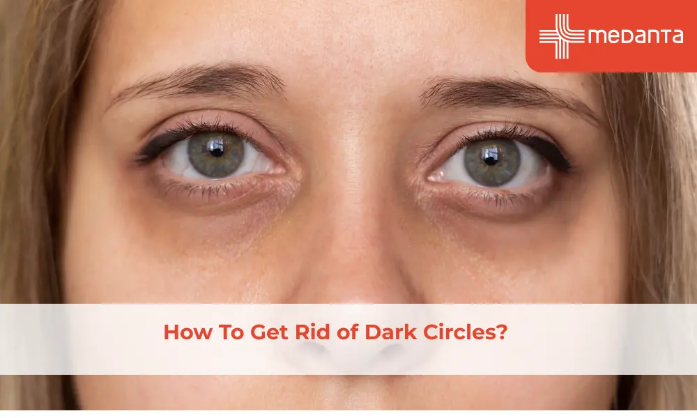 how-to-get-rid-of-dark-circles