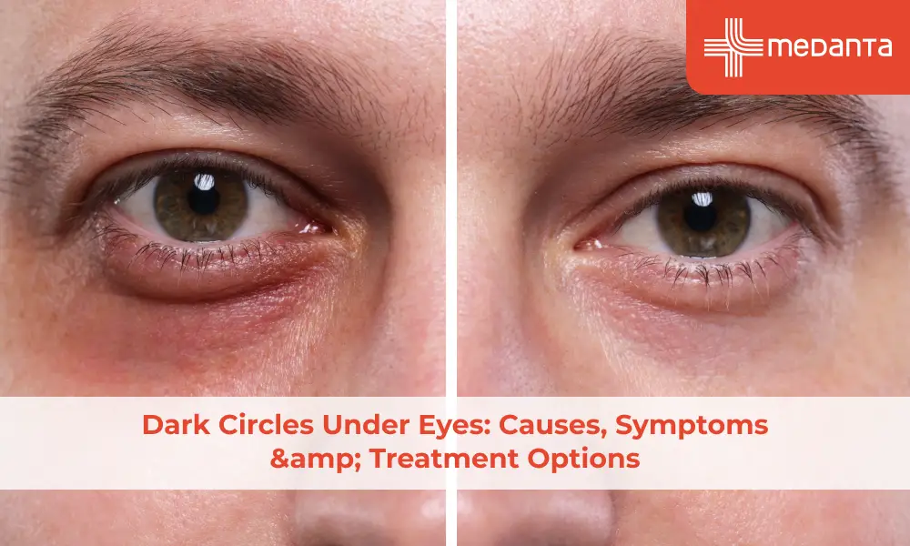 Dark Circles Under Eyes: Causes, Symptoms & Treatment Options