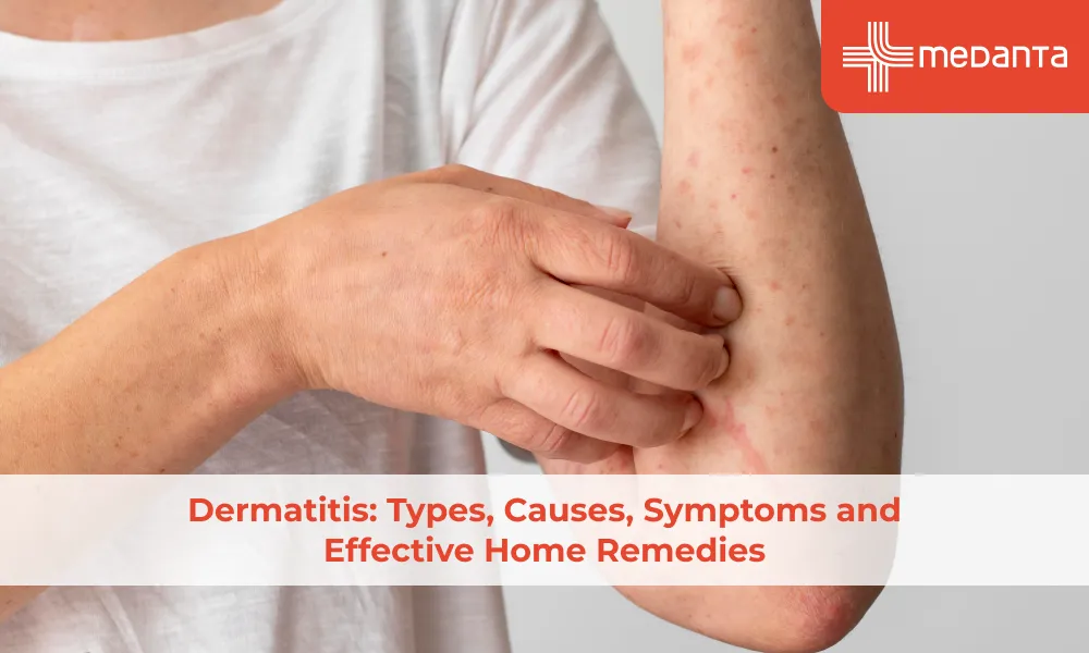 dermatitis-types-causes-symptoms-and-effective-home-remedies