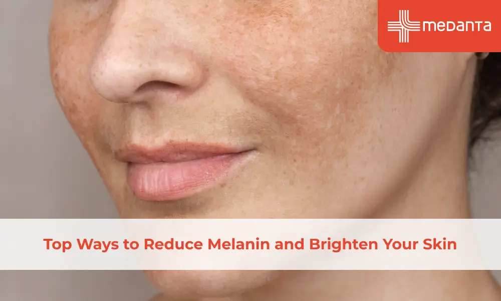 Top Ways to Reduce Melanin and Brighten Your Skin