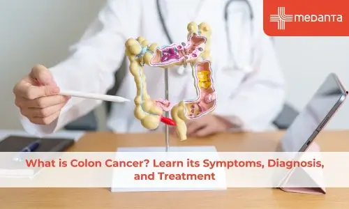 What is Colon Cancer? Learn its Symptoms, Diagnosis, and Treatment