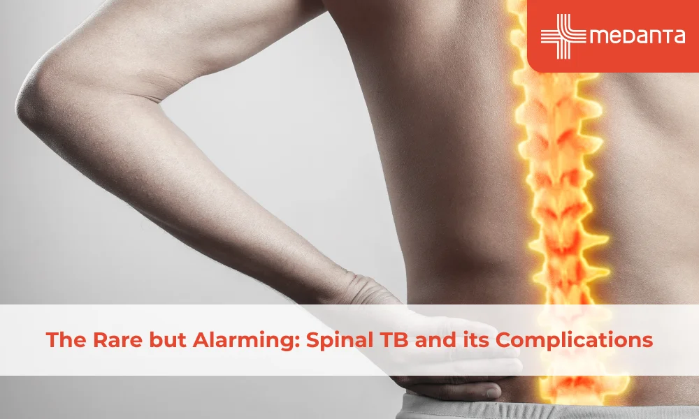 The Rare but Alarming: Spinal TB and its Complications
